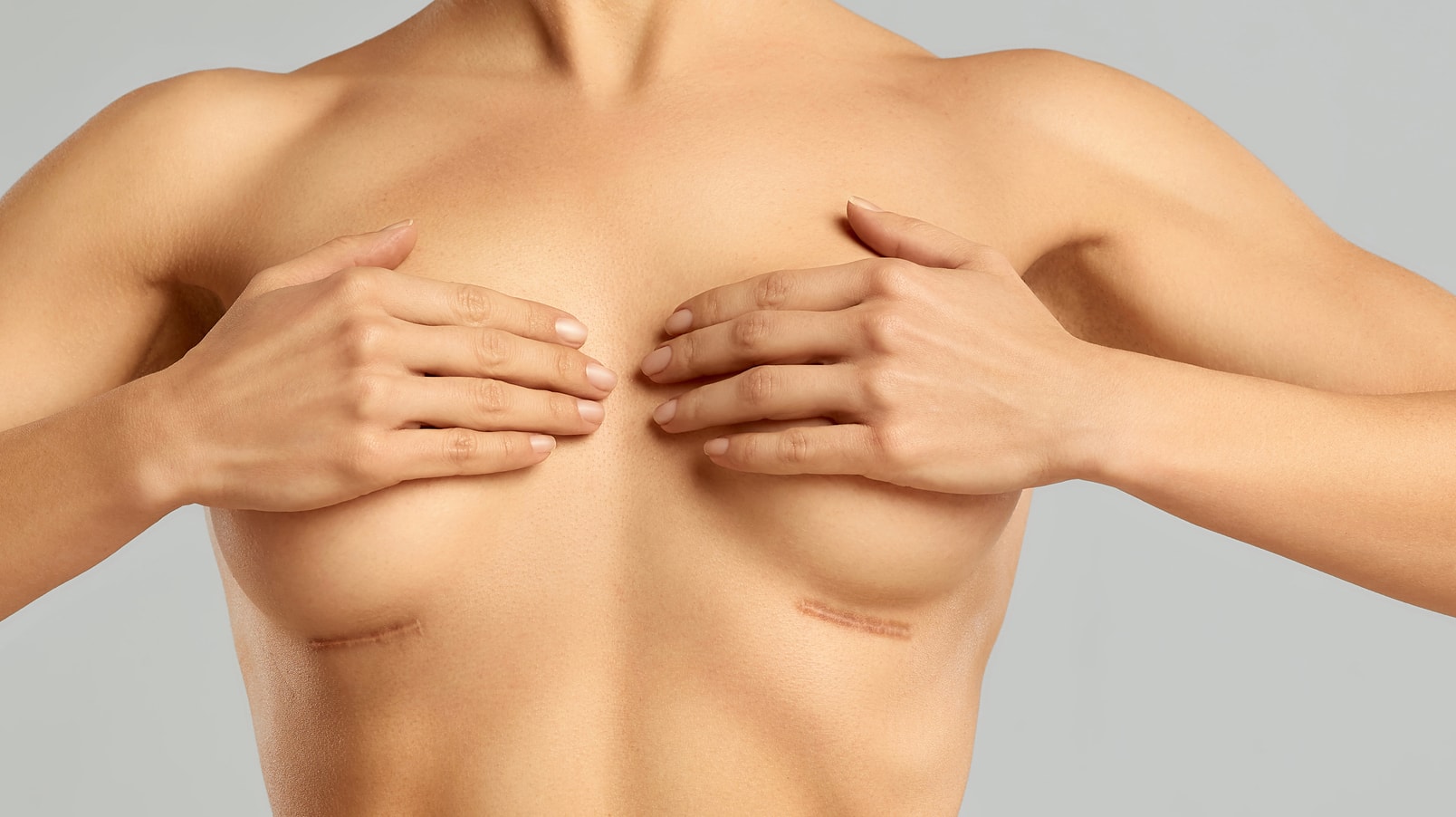 Breast Augmentation Sub muscular IMF Incision 