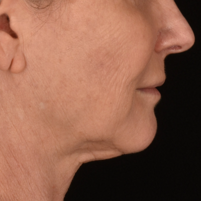 Lower Face and Neck Lift