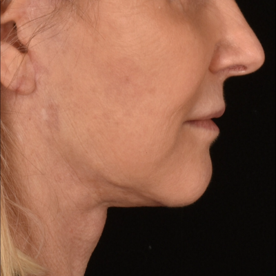 Lower Face and Neck Lift
