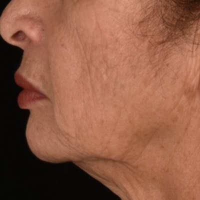 Lower Face and Neck Lift