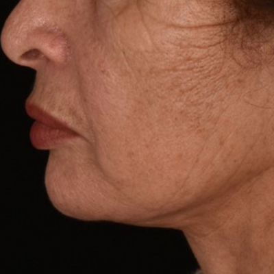 Lower Face and Neck Lift