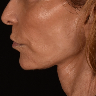 Micro Neck Lift