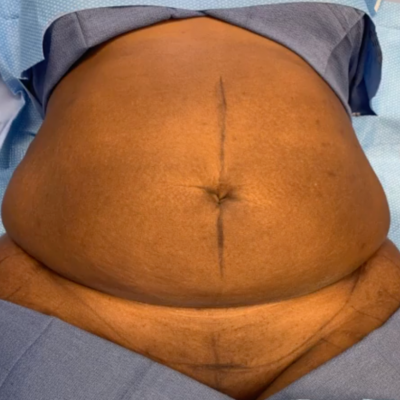 Tummy Tuck