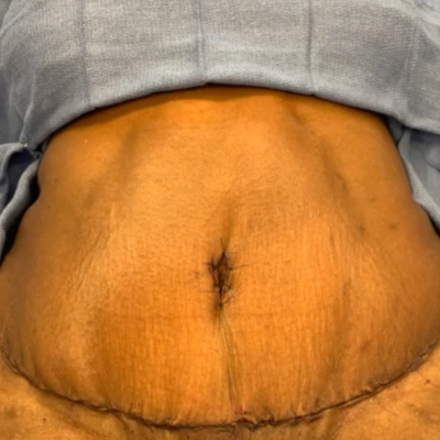 Tummy Tuck