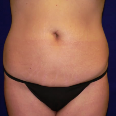 Tummy Tuck Before and After