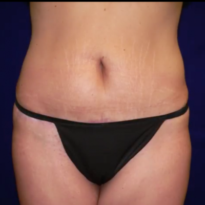 Tummy Tuck Before and After