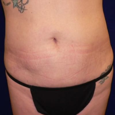 Tummy Tuck