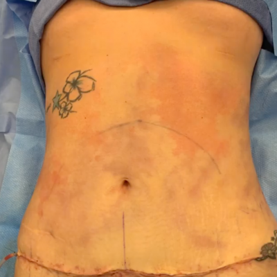 Tummy Tuck