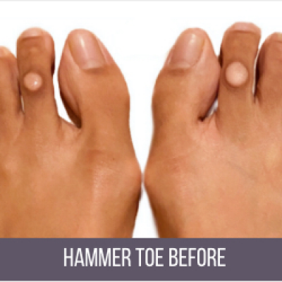Hammer Toe