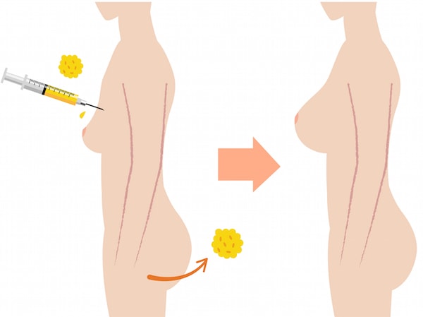 Fat transfer help patients change their appearance and augment different parts of the body. There are also some risks associated with the procedure.