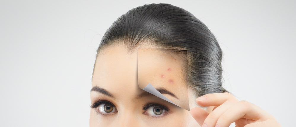 Acne Scars Issues - How to Get Rid of Them with Microneedling