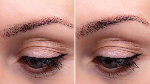 Brow Lift Results