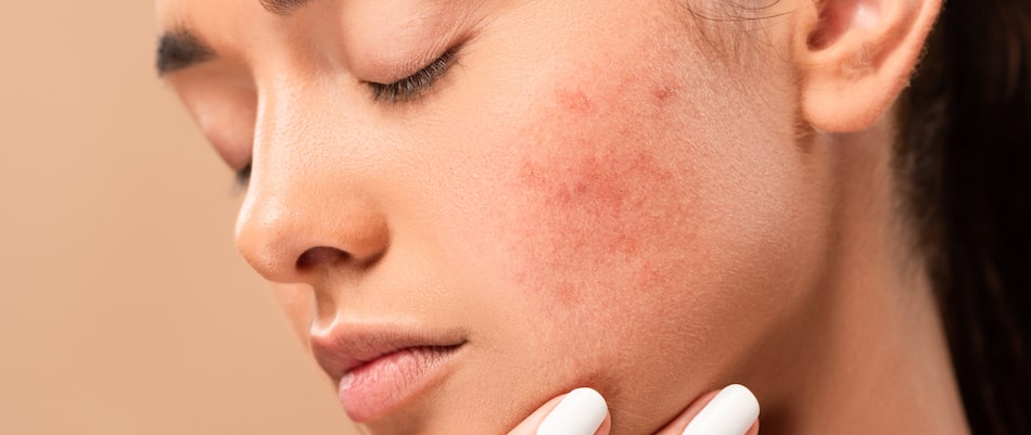 Learn how plastic surgery can eliminate acne scars