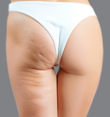 Cellulaze Treatment Before and After
