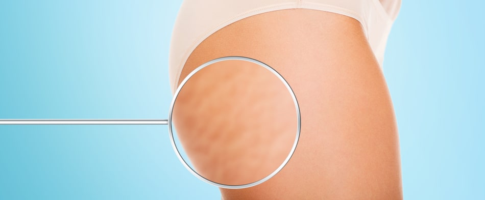 Treat your cellulite with cellulaze
