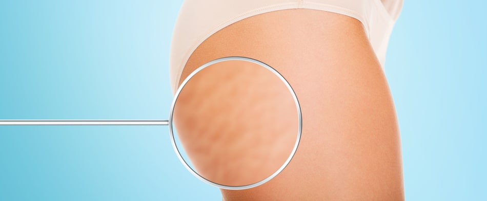 Zap Away Cellulite with Cellulaze Treatments 