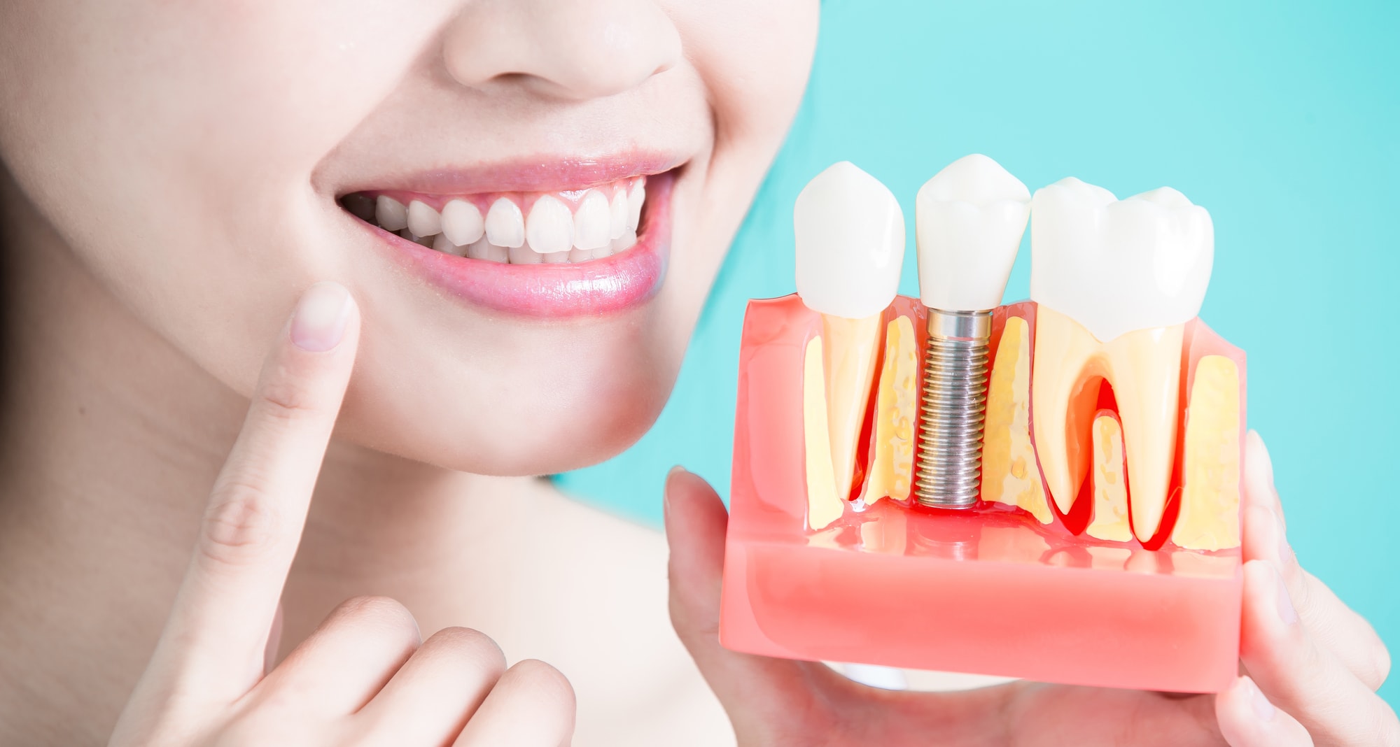 Hollywood cosmetic dentist explains how dental implants work