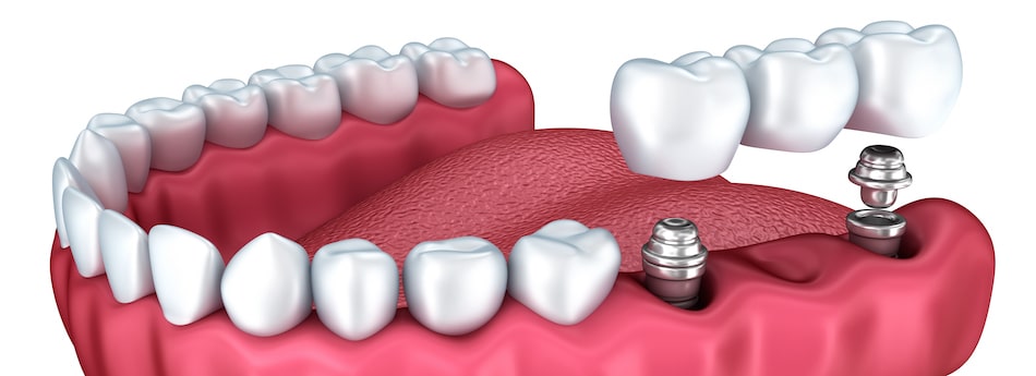 Dental Bridges - How They Benefit the Mouth