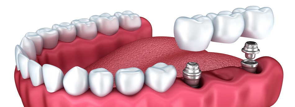 Dental bridge how they help