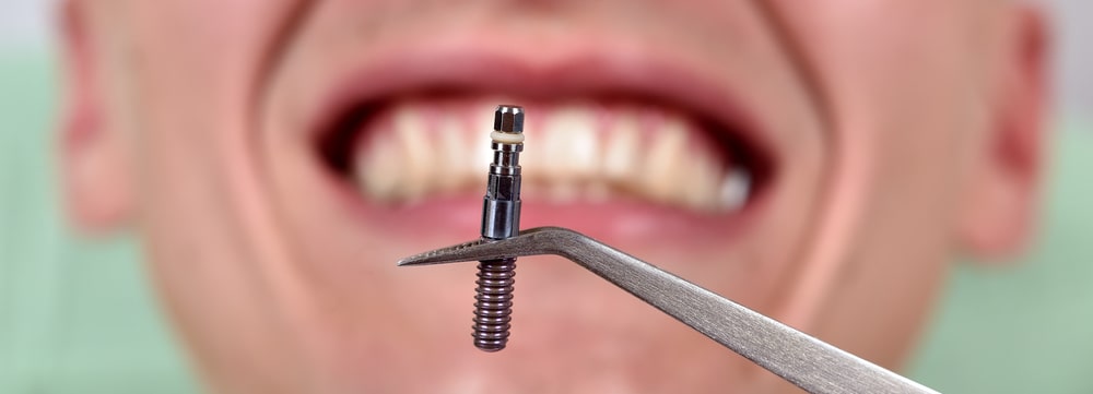 What to Expect with a Dental Implant Process- Explained
