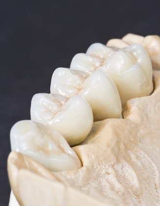 Different Types of Dental Bridge