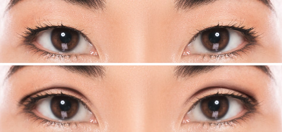 Double Eyelid Surgery at The Age of Nine – Details Here