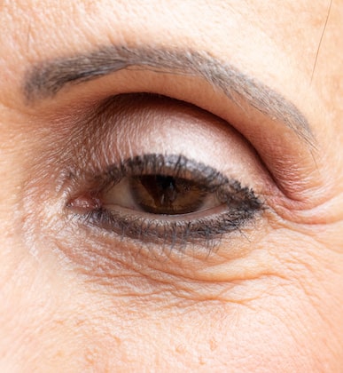 Droopy Eyelid Common Symptoms