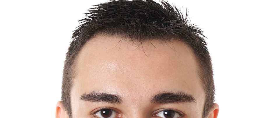 Forehead Reduction Surgery - What You Need to Know