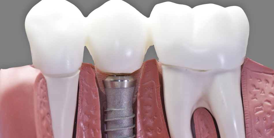 Dental implants can improve your mouth
