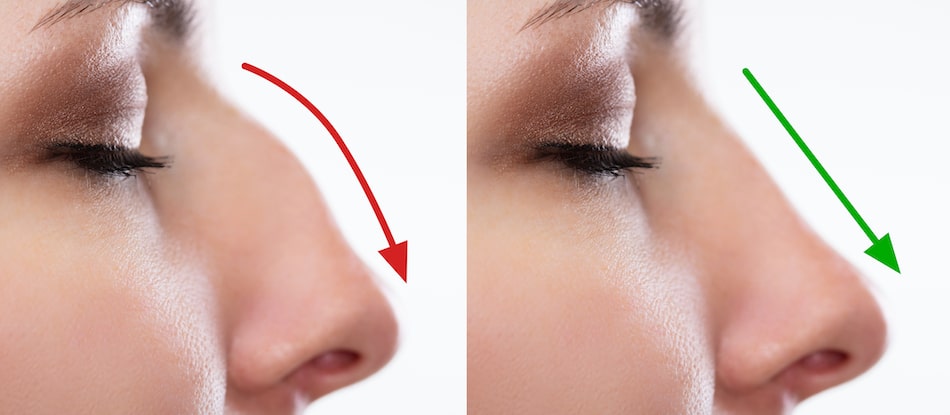 See how a closed rhinoplasty works