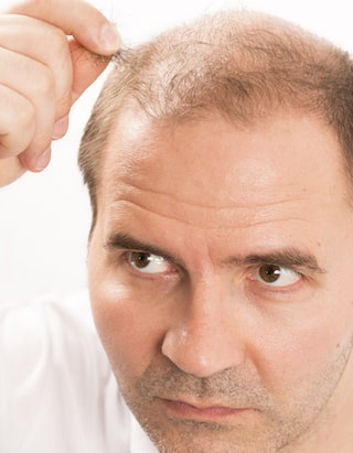 4,000 Graft FUE Hair Transplant For Diffuse Hair Loss - AlviArmani - Hair  Transplant Los Angeles