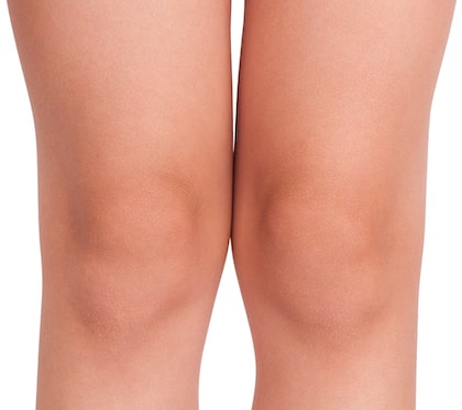 How is Knee Liposuction Performed
