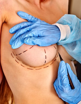 Improved Nipples After Mastectomy