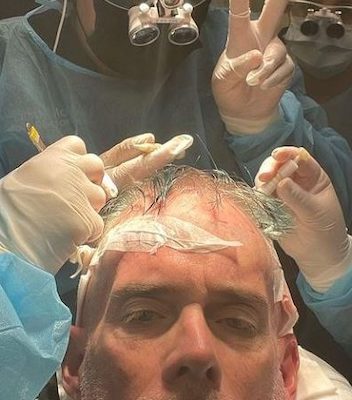 Joe Buck Hair Transplant History