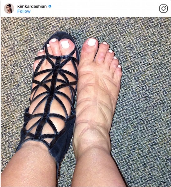 Kim Kardashian Having Plastic Surgery To Cure Cankles?