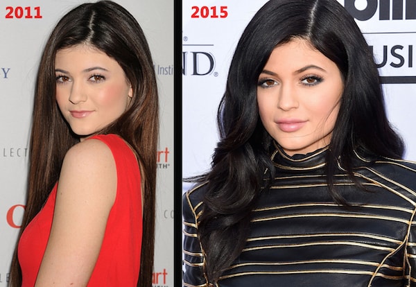 Kylie Jenner and Plastic Surgery