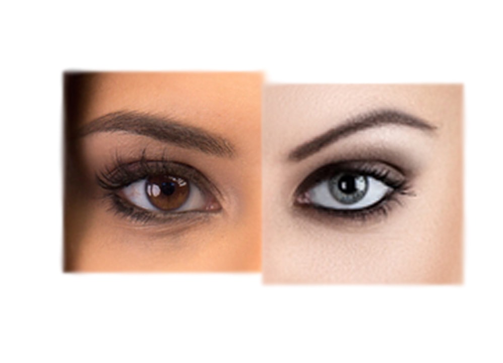 Stroma Laser Procedure Turns your Brown Eyes Blue