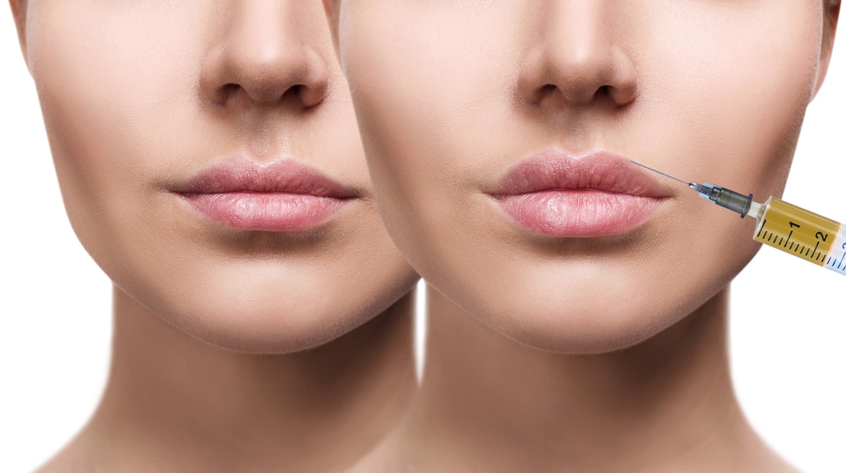 Discover the Changes Made to the Lips Thanks to Lip Fillers