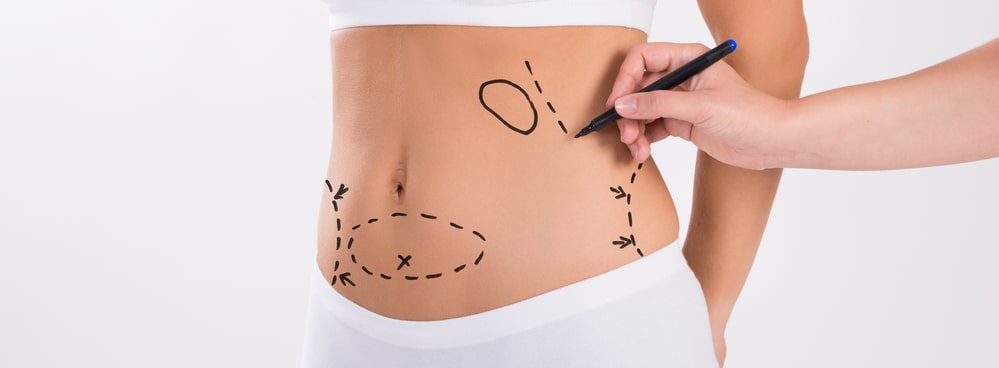 Learn about Liposuction 360°