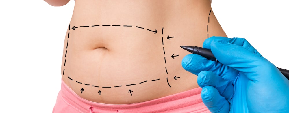 Liposuction Facts and Misconceptions