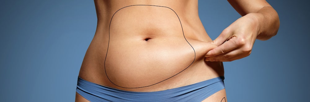 Liposuction removes all the fat