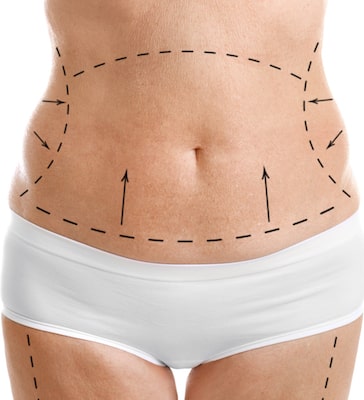 Liposuction Risks