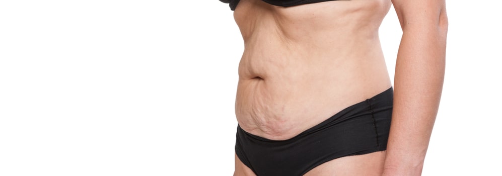 What to do for saggy skin after weight loss