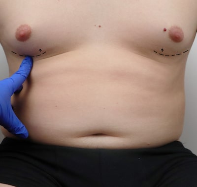 Male cosmetic breast reduction