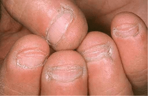 Nail Biting! Habit or Horrible Health Hazard? | Cosmetic Town