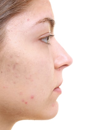Nonsurgical Acne Treatments