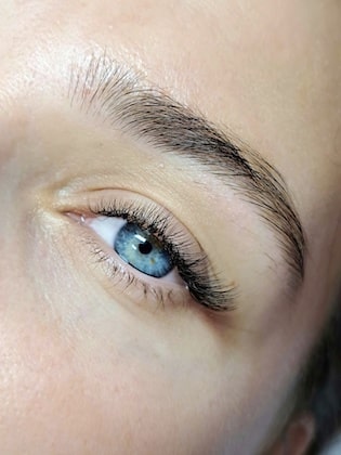 Nonsurgical eyelid lift treatments