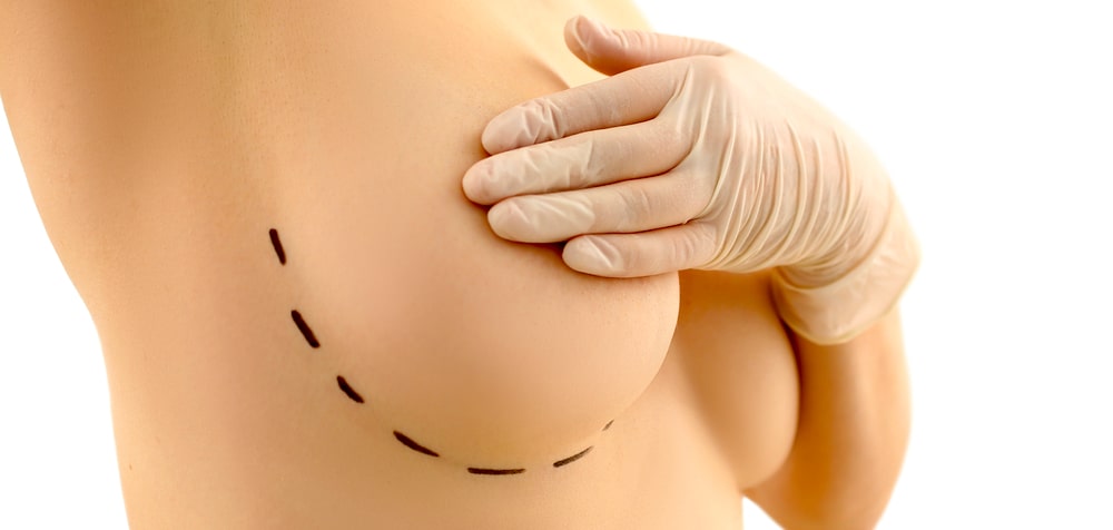 Breast implant removal story of a personal trainer