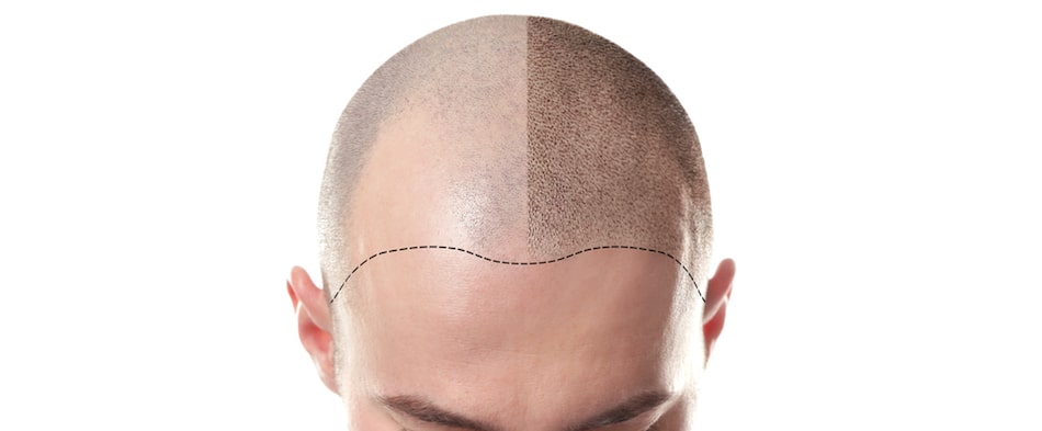 Scalp Micropigmentation to help to image of Hair Loss