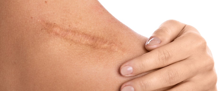 Don’t Live with Surgery Scars – Scar Revision Secrets